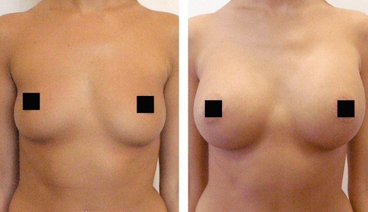breast before and after breast augmentation with hyaluronic acid