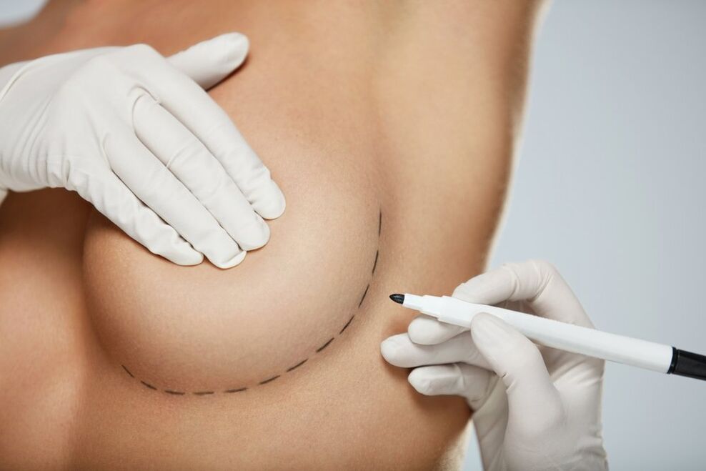 Breast reconstruction around the breast