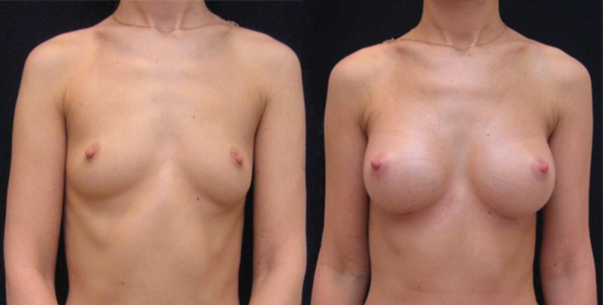 Breast before and after endoscopic lift