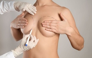 Surgical breast augmentation method