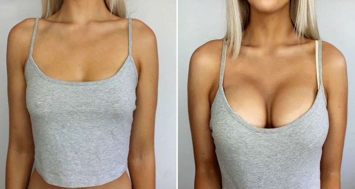 Breast expansion 3 sizes