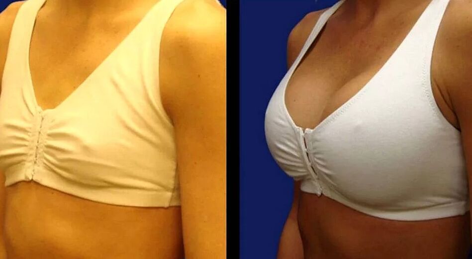 Breast photos before and after surgery