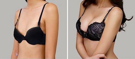 Photo before and after breast augmentation