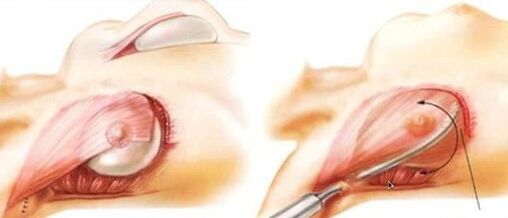 How is the breast lifting activity performed