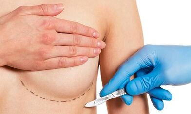 Visit Submammaric to expand breasts with implants