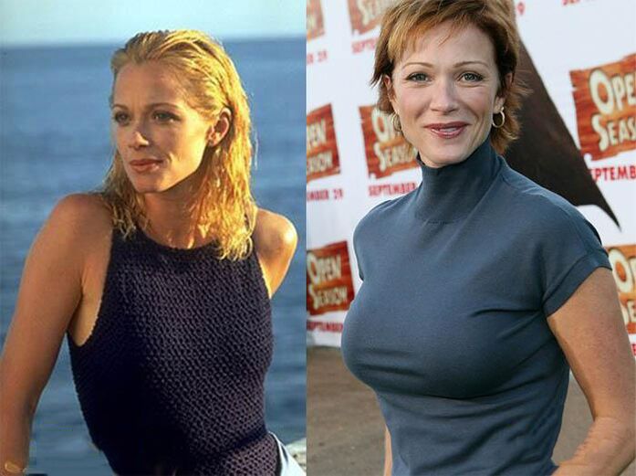 Before and after shaping surgery