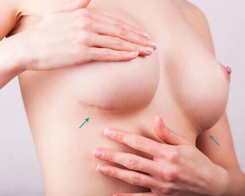 Breast expansion with transplantation