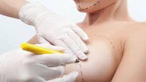 Breast augmentation surgery