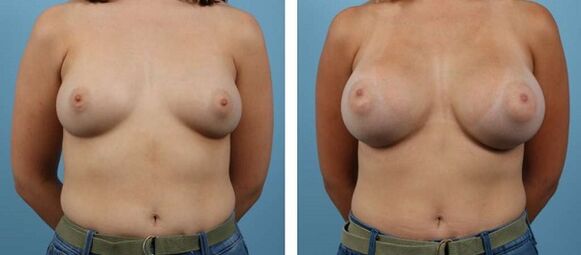 Before and after breast augmentation images