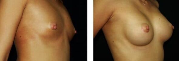 before and after breast augmentation