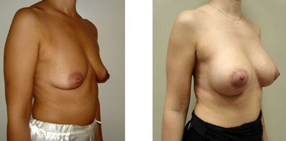 breasts before and after breast augmentation