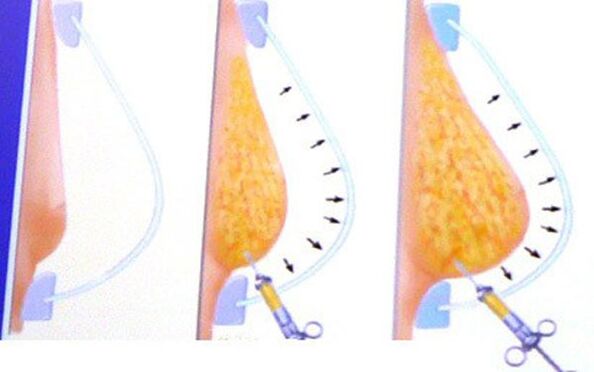Breast enlargement with fat