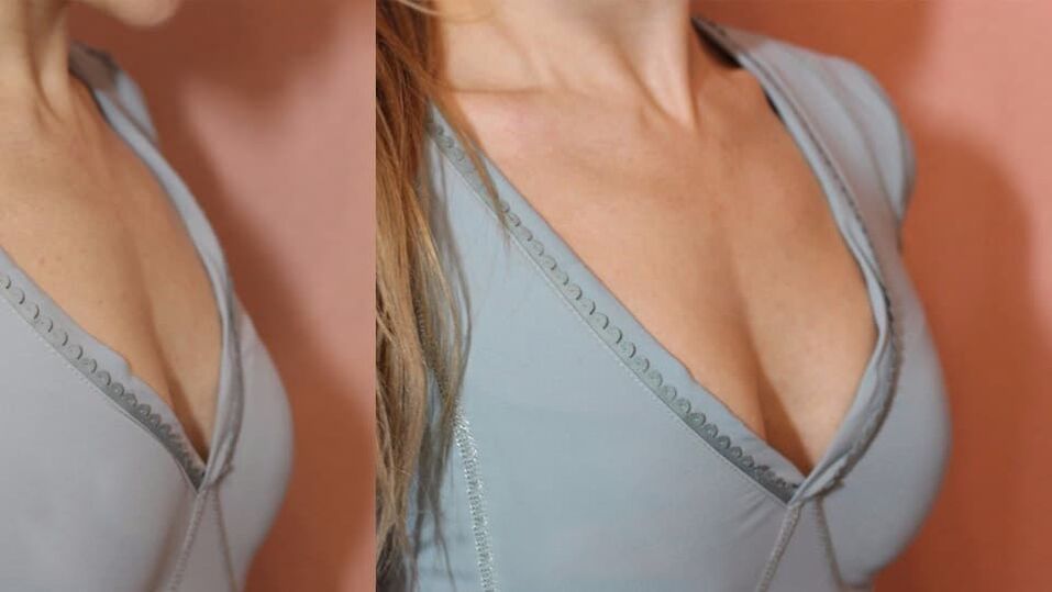 Products before and after breast augmentation