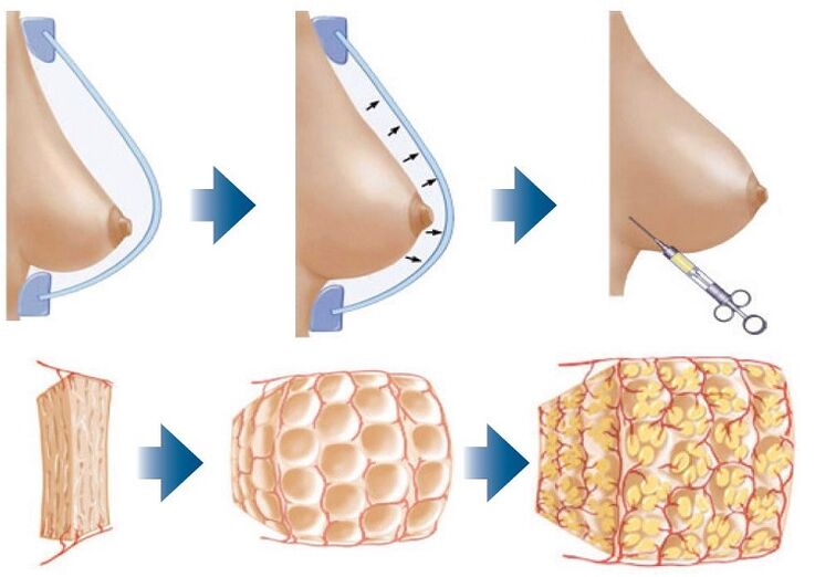 Breast augmentation surgery method
