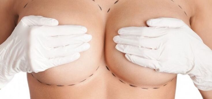 breast augmentation surgery