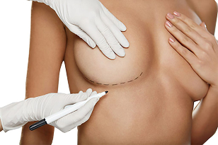 Mark with marker before breast augmentation surgery