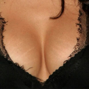 Indications for breast augmentation